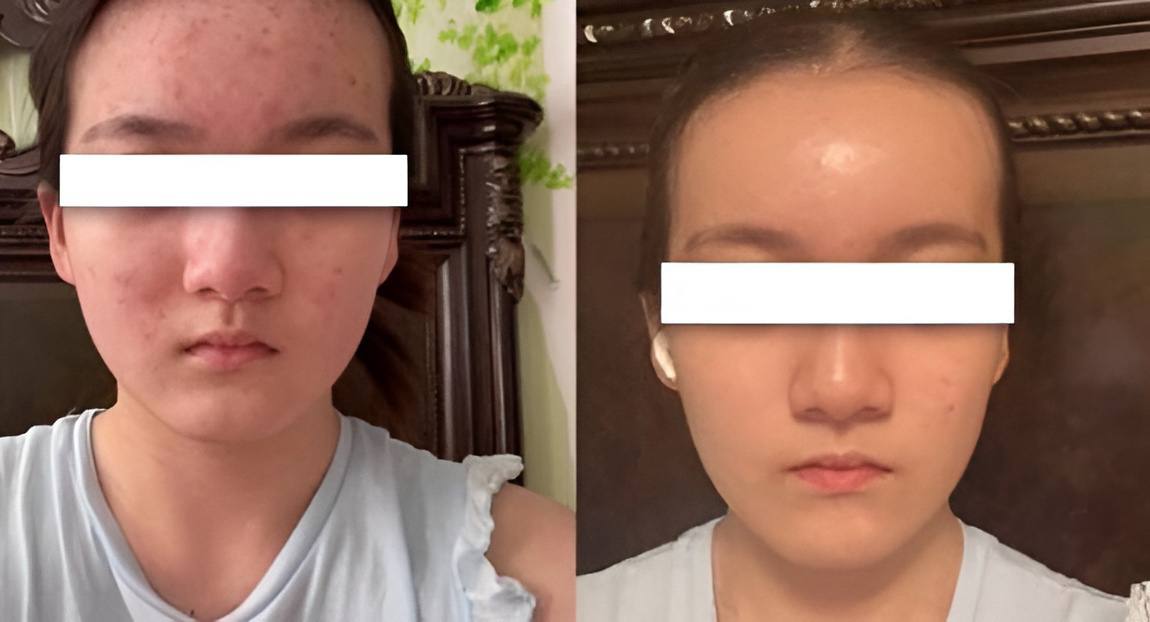 Acne Edit Starter Kit ❣️