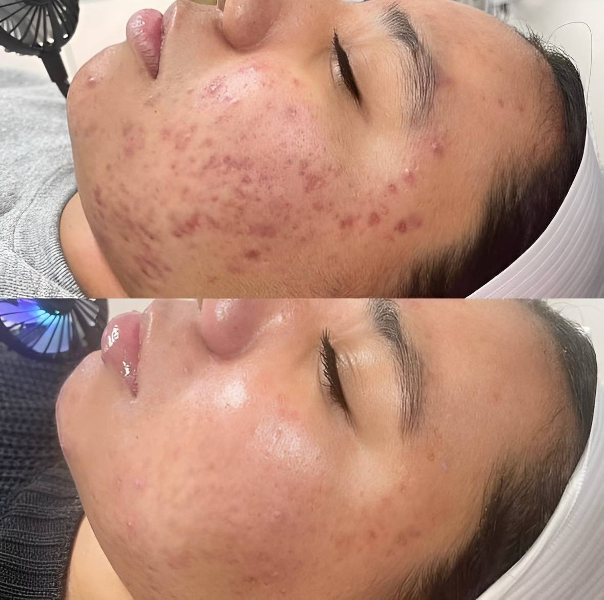 Acne Edit Starter Kit ❣️